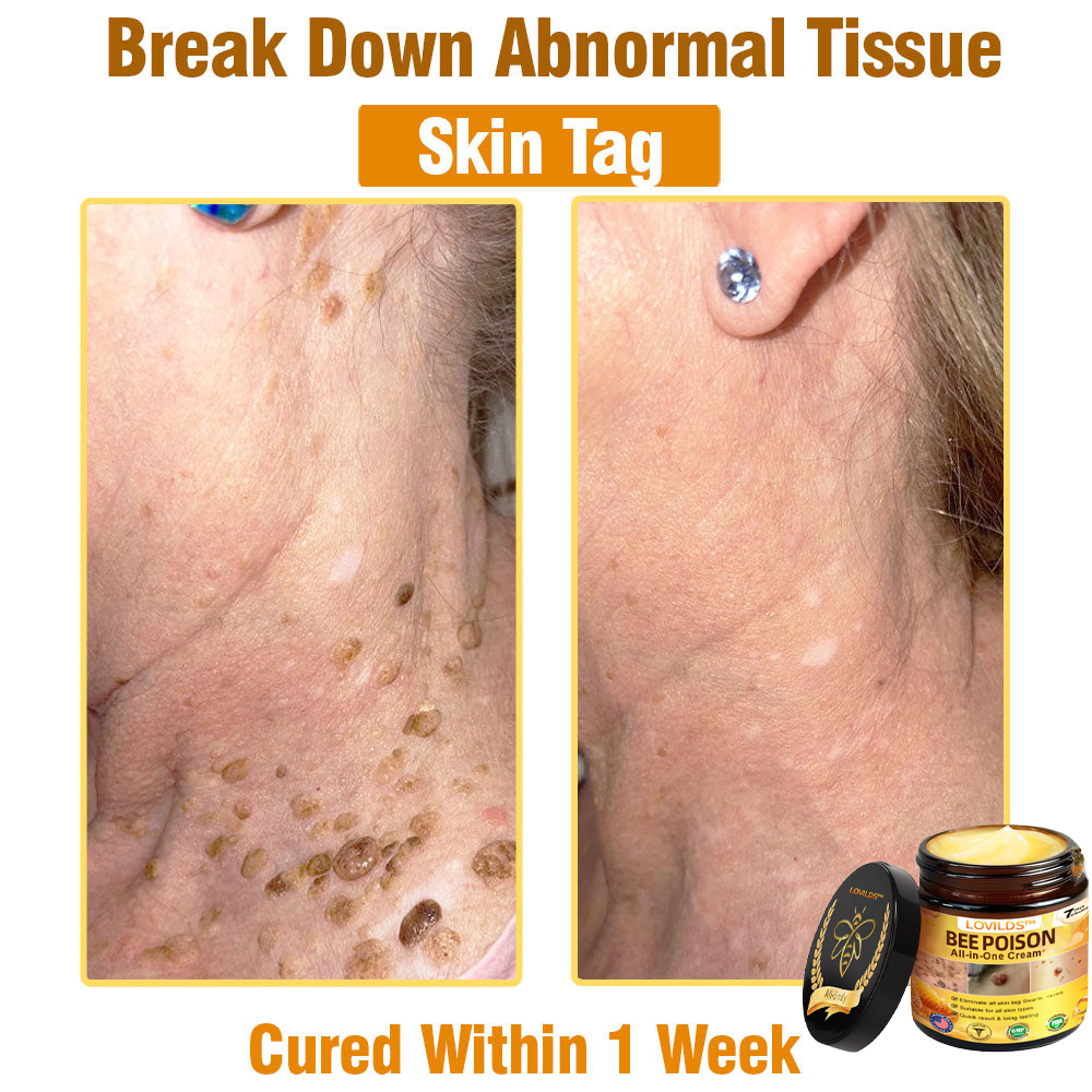 LOVILDS™ Bee Poison All-in-One Cream US Dermatologist Approved